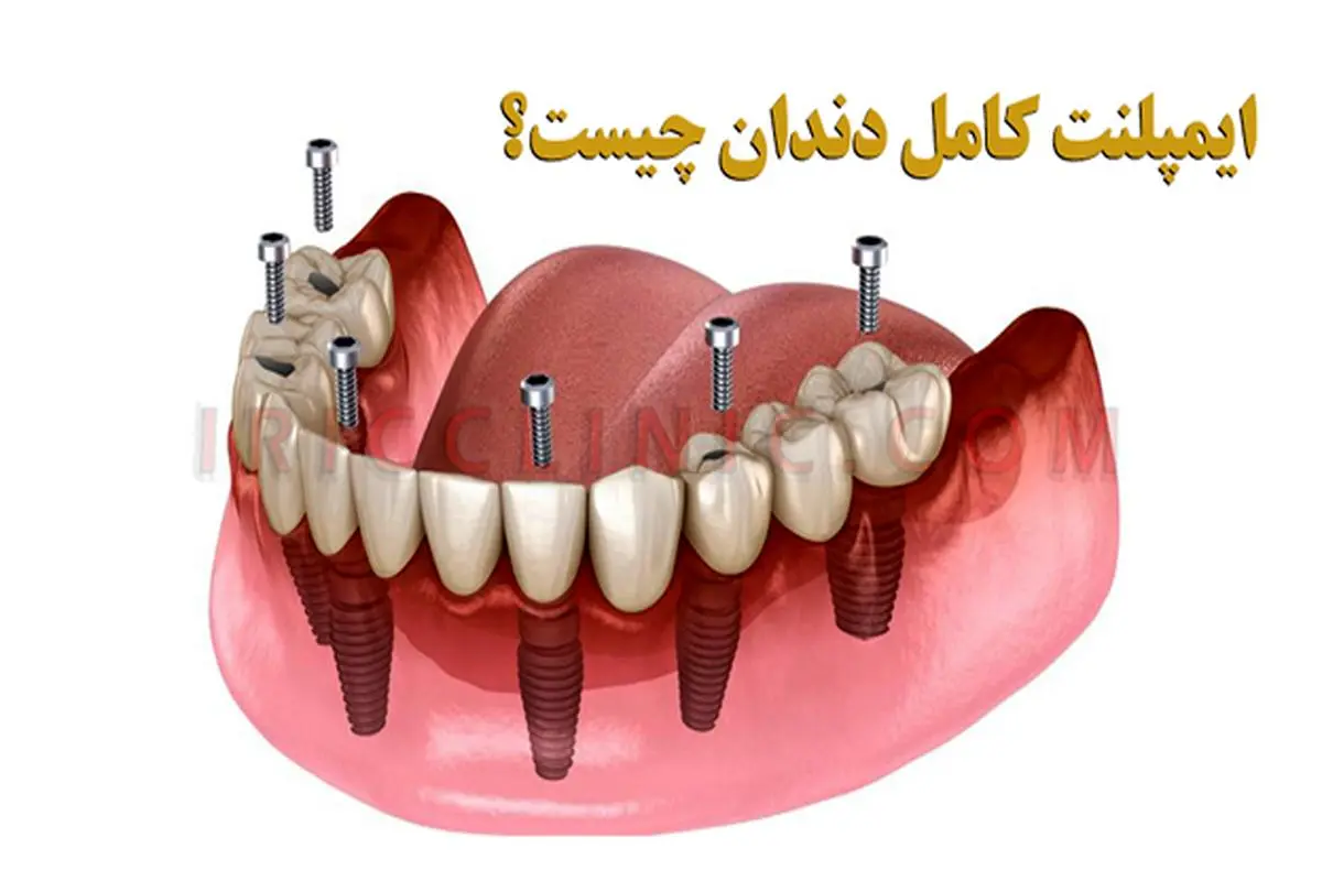 ایمپلنت کامل دندان + لیست قیمت در تهران
