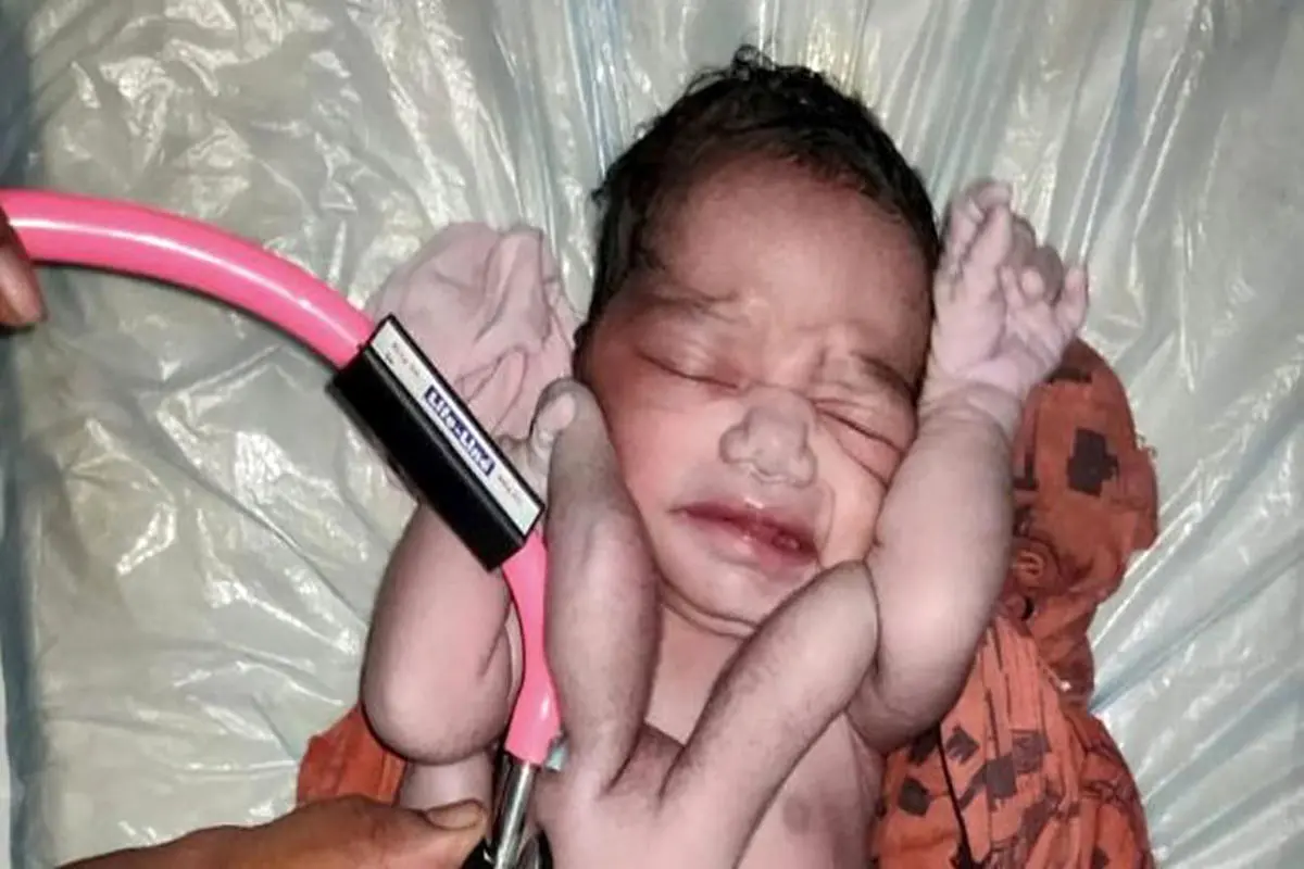 عجیب ترین نوزاد جهان به دنیا آمد | عکس نوزاد 4 دست و پا