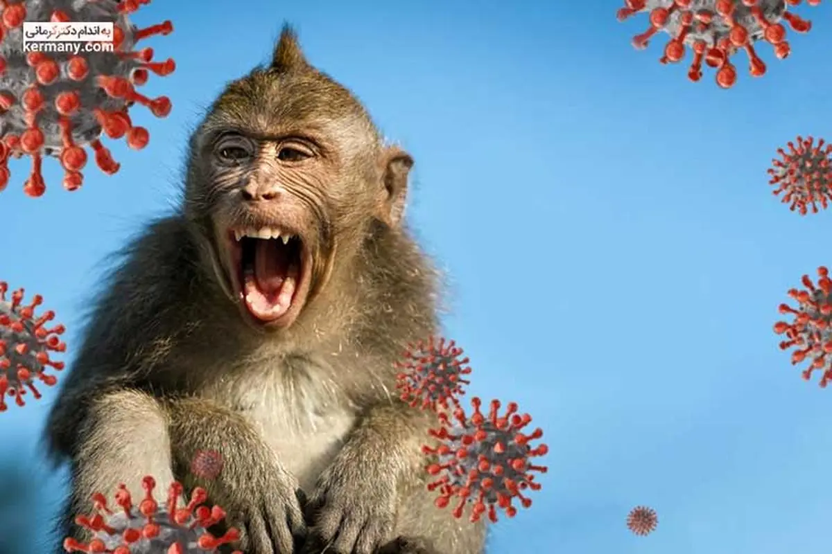 آخرین وضعیت آبله میمونی در کشور | آمار جهانی آبله میمونی چه می گوید؟
